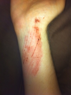 Grazed Wrist